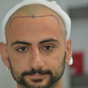 Identical twin hair transplant 28.jpg