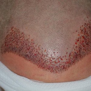 Identical twin hair transplant 29.jpg
