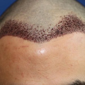 Identical twin hair transplant 31.jpg
