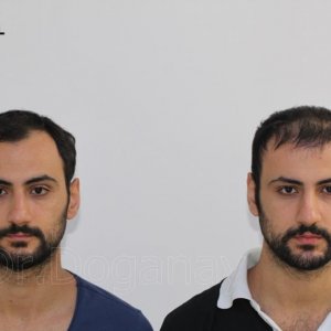 Identical twin hair transplant 32.jpg