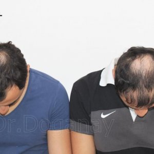 Identical twin hair transplant 33.jpg