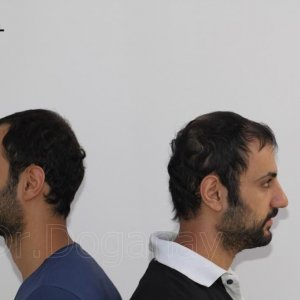 Identical twin hair transplant 34.jpg
