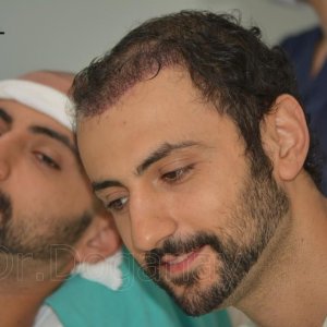 Identical twin hair transplant 36.jpg