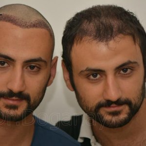 Identical twin hair transplant 37.jpg