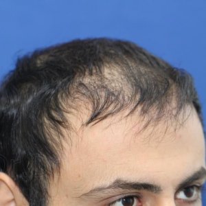 identical twin hair transplant 7.jpg