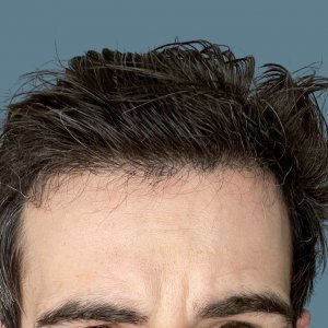 dr-nikos-hair-transplant-result.jpg