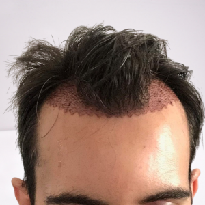 post-op-dr-nikos-removebg.png