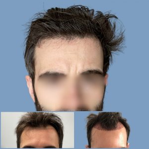 before-placement-hair-transplant-result-dr-nikos.jpg