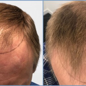 before-dr-nikos-hair-transplant.jpg