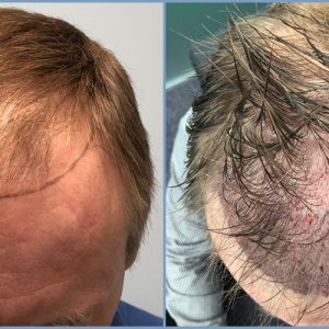 before-graft-placement-dr-nikos.jpg