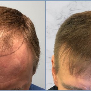 front-hair-transplant-result-dr-nikos.jpg