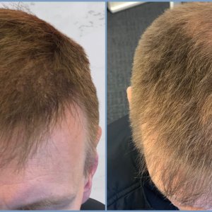 hair-transplant-result-dr-nikos.jpg
