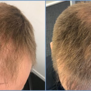 hair-transplant-top-result-dr-nikos.jpg