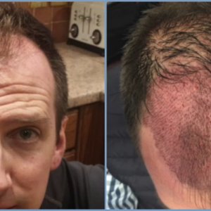 before-graft-placement-dr-nikos-hair-transplant.jpg