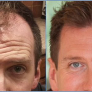 before-hair-transplant-result-dr-nikos.jpg