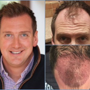 dr-nikos-hair-transplant-collage.jpg