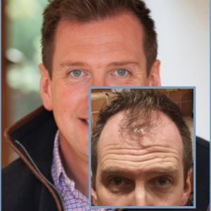 dr-nikos-hair-transplant-result.jpg