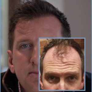 dr-nikos-hair-transplant-result.1.jpg