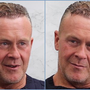 after-sides-dr-nikos-hairtransplant-result.jpg