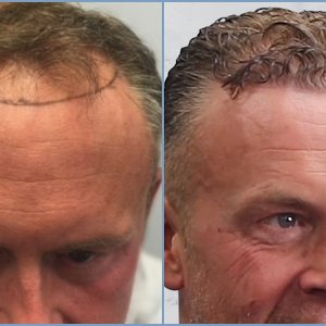 before-after-dr-nikos-hair-transplant-result.jpg