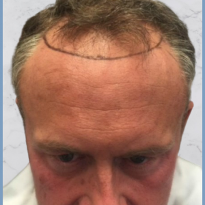 hairline-design-dr-nikos-hair-transplant-.png