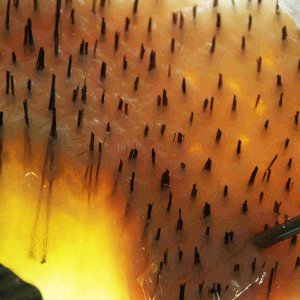 Donor-area-hair-transplant-fut.jpg