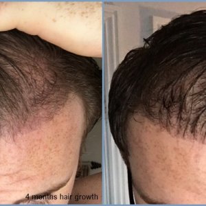 4-5-month-post-op-dr-nikos-hair-transplant.jpg