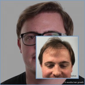 before-6-month-dr-nikos-hair-transplant.jpg