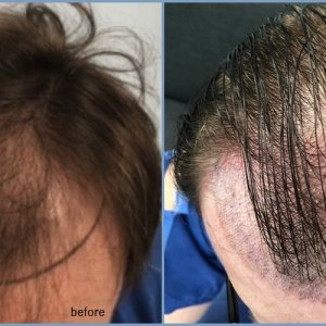before-graft-placement-dr-nikos.jpg