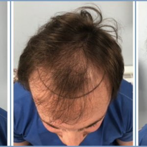 before-hair-transplant-dr-nikos.jpg
