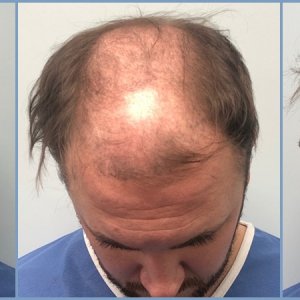 before.hair-transolant-with-dr-nikos.jpg