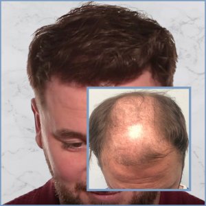 before.top-result-hair-transplant-dr-nikos.jpg