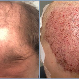 before-placement-dr-nikos-hair-transplant.jpg