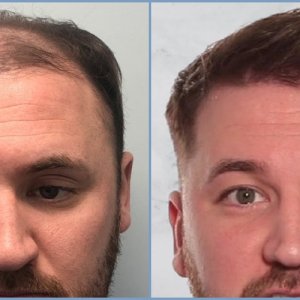 before-result-hair-transplant-dr-nikos.jpg