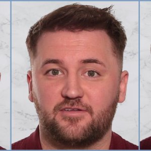 hair-transplant-result-dr-nikos.jpg