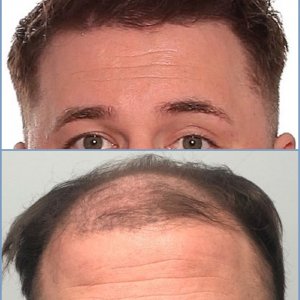j-before-after-hairline-dr-nikos-hair-transplant-result.jpg