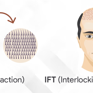 Interlocking fue technique: Natural Hair Results with IFT Technique