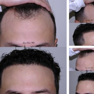 Hair-Transplant