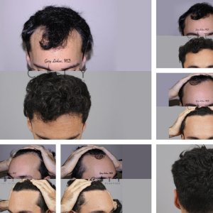 Hair-Transplant