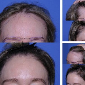 Hair-Transplant