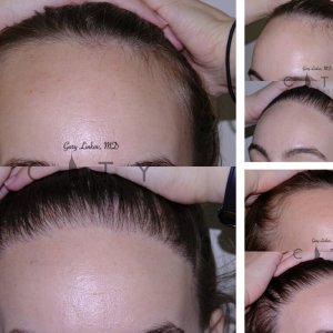 Hair-Transplant