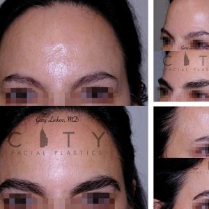 Hair-Transplant