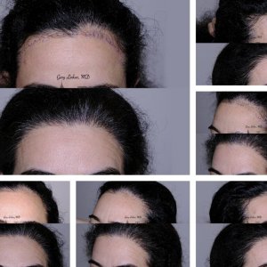 Hair-Transplant
