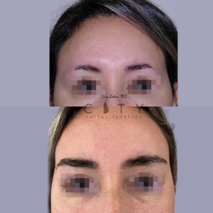 Hair-Transplant