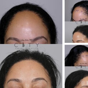 Hair-Transplant