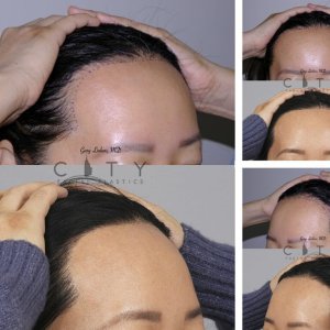 Hair-Transplant