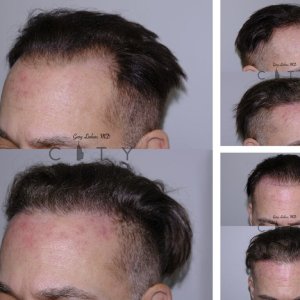 Hair-Transplant