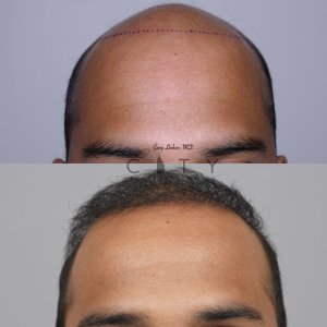 Hair-Transplant