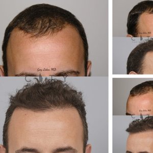 Hair-Transplant