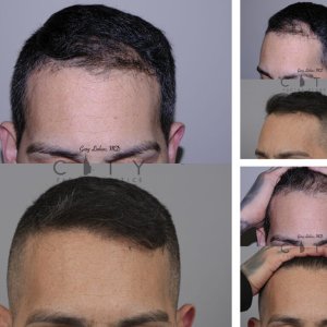 Hair-Transplant